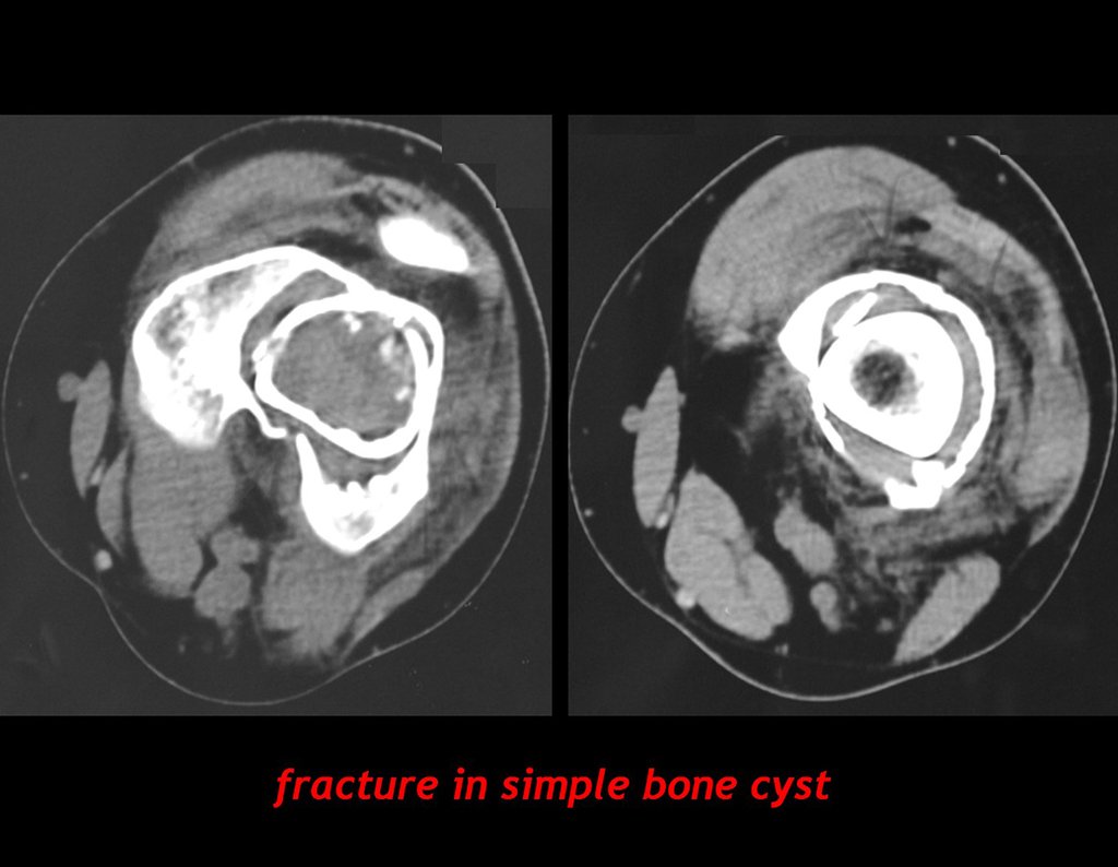 Figura 51: Tomografia de fratura em cisto ósseo simples. A cortical do segmento proximal aparece afundada dentro da falha óssea na epífise.