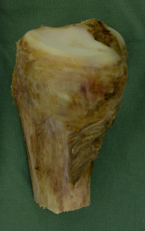 anterior. Figura 86. B: Região póstero medial recoberta por tecido muscular, macroscopicamente normal, como margem de segurança oncológica.