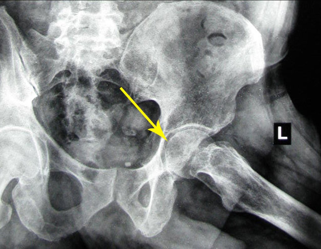 Figura 63: Radiografia da bacia em Lowenstein com acentuação da osteoporose no fêmur.