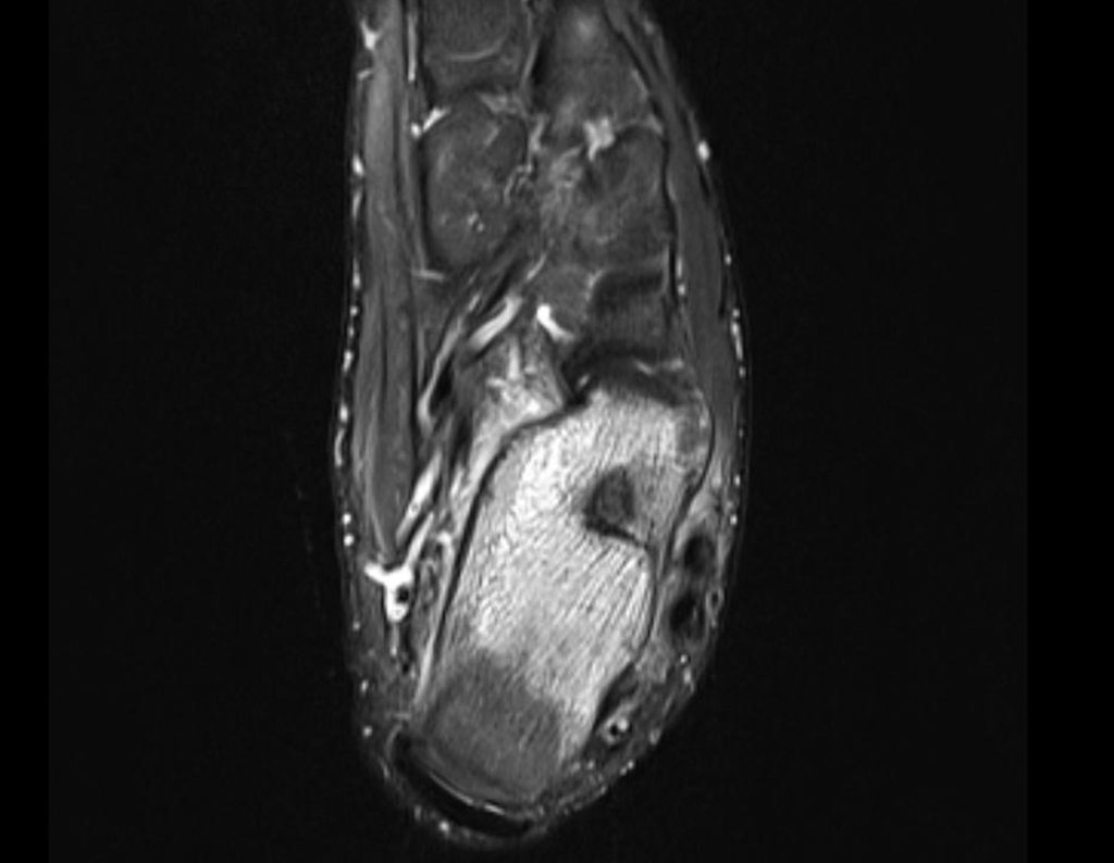 Figura 34: RM axial T2 stir, continuidade da lesão.