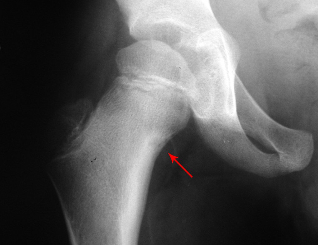 Figura 4: Detalhe do quadril direito ampliado, lesão na cortical medial do colo femoral direito, rarefação óssea com halo de esclerose.