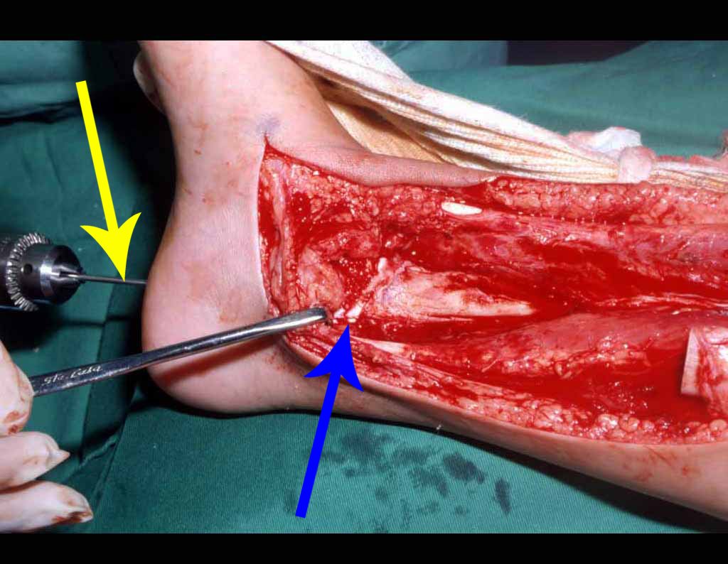 Figura 16: Passagem de fio de Kirschner (seta amarela) pelo calcâneo-tálus-epífise fibular-placa de crescimento-diáfise da fíbula-tíbia proximal, estabilizando a reconstrução com uma síntese mínima, geralmente suficiente e de baixa morbidade para as crianças. A seta azul evidencia a placa de crescimento da fíbula, que substituirá a da tíbia.