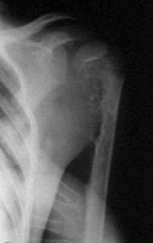 Figura 1: Radiografia do úmero, frente, com lesão de rarefação óssea metafisária, comprometendo a placa de crescimento, em 10/02/1991.