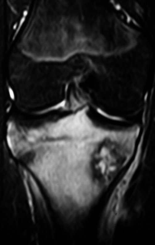 Figura 3. A: RM cor coronal T2, com supressão de gordura, lesão heterogênea.