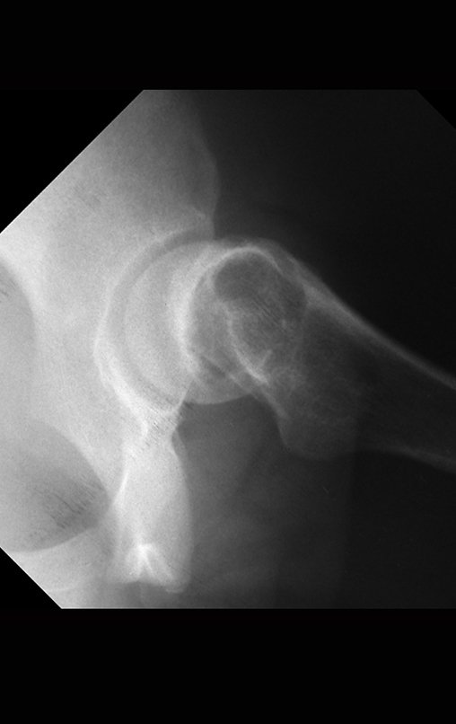 Figura 7: Radiografia da bacia em alar, de outubro de 2004, mostrando o desvio posterior da cabeça femoral.