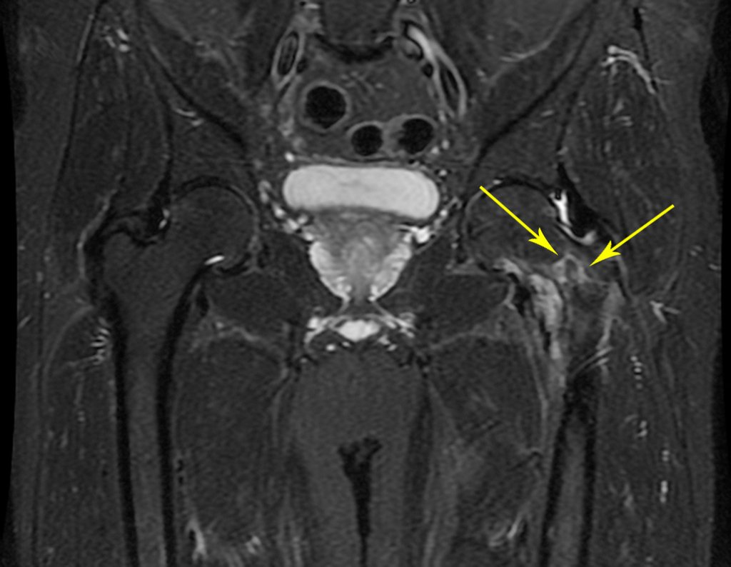 Figura 53: RM coronal com traços de fratura no colo, setas em amarelo.