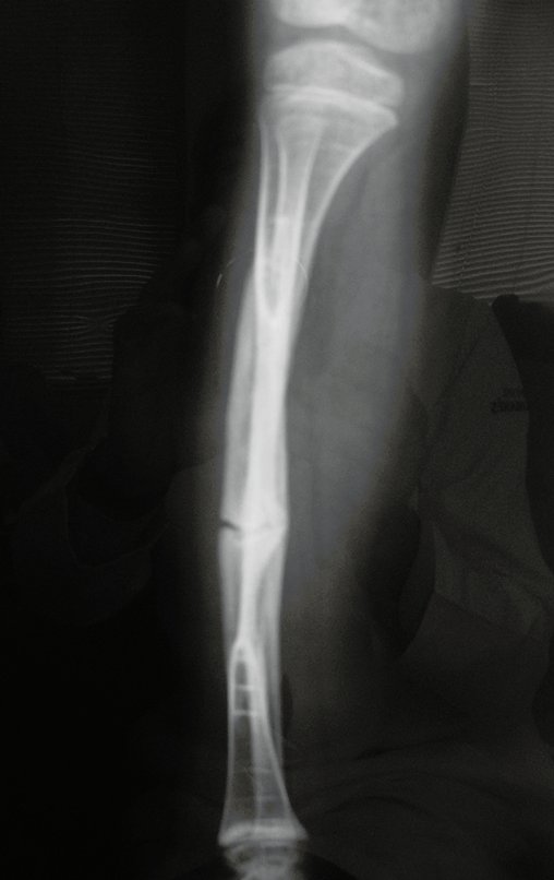 Figura 152: Radiografia frente, em 10/11/2015