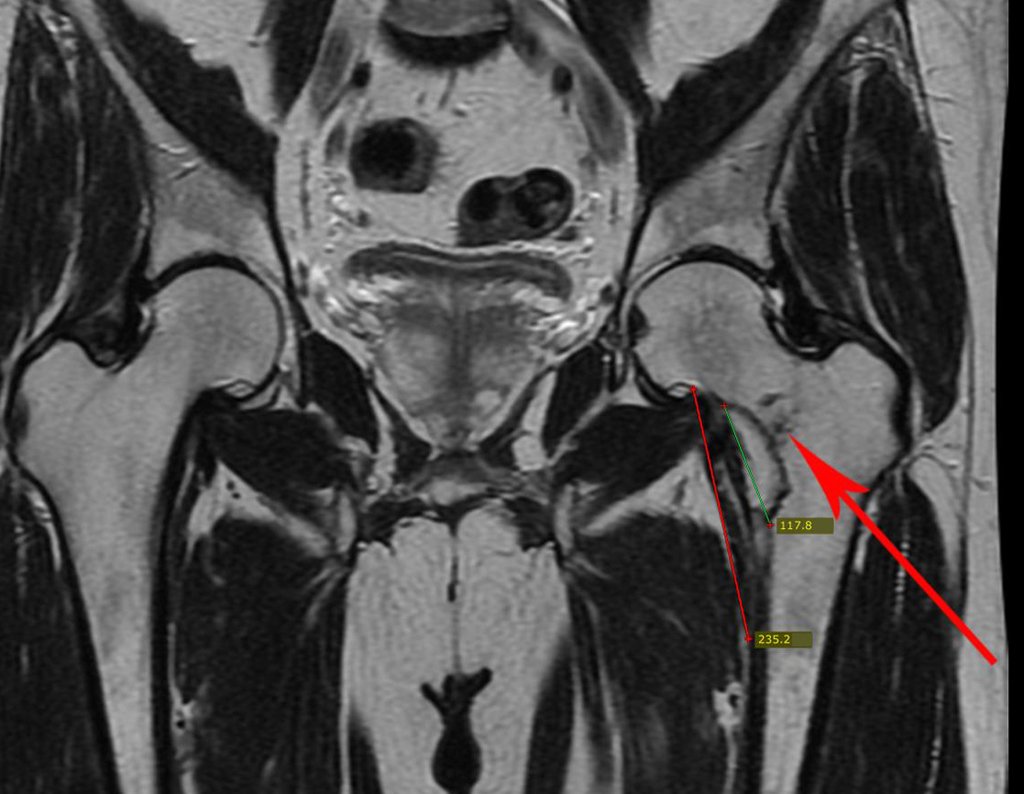 Figura 43: A lesão continua aumentando e aparece sinal de traço de fratura incompleta no colo femoral, seta em vermelho.