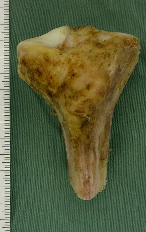 Figura 86. A: Peça de osteossarcoma diagnosticado precocemente, ressecada com margem oncológica na face anterior, lateral e medial.