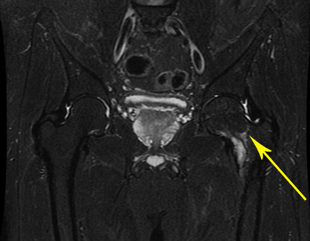 Figura 47: RM coronal com saturação de gordura evidenciando o traço de fratura no colo femoral, seta em amarelo.