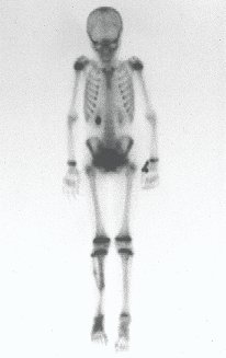 Figura 31: Cintilografia óssea, fase tardia, mostrando captação no 1/3 distal da perna, confirmando a presença de vascularização da fíbula transplantada.