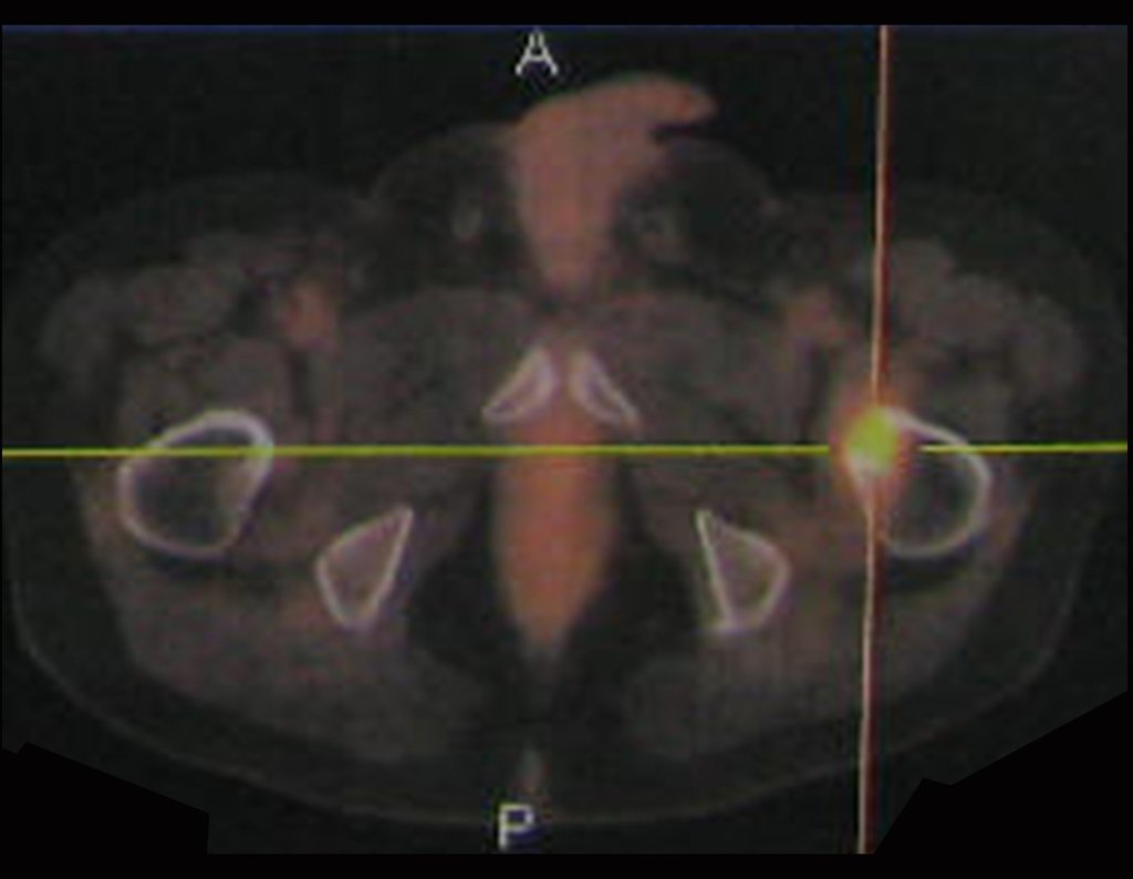 Figura 17: Pet-Ct, corte axial, lesão no pequeno trocânter.