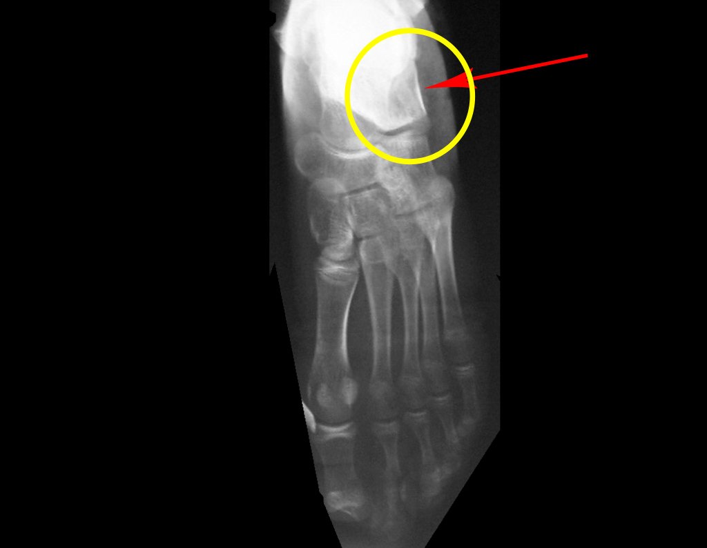 Figura 68: Radiografia do pós-operatório imediato, após a colocação do enxerto do Ilíaco. O círculo em amarelo evidencia a reconstituição da anatomia do calcâneo, a seta vermelha destaca o enxerto colocado.