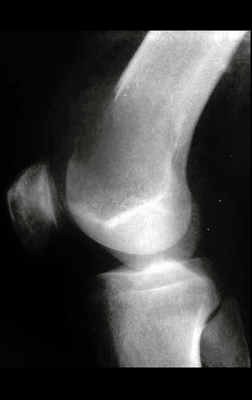 Figura 40: Radiografia do joelho, perfil, grande lesão epífise metafisária do fêmur direito, com erosão da cortical anterior.