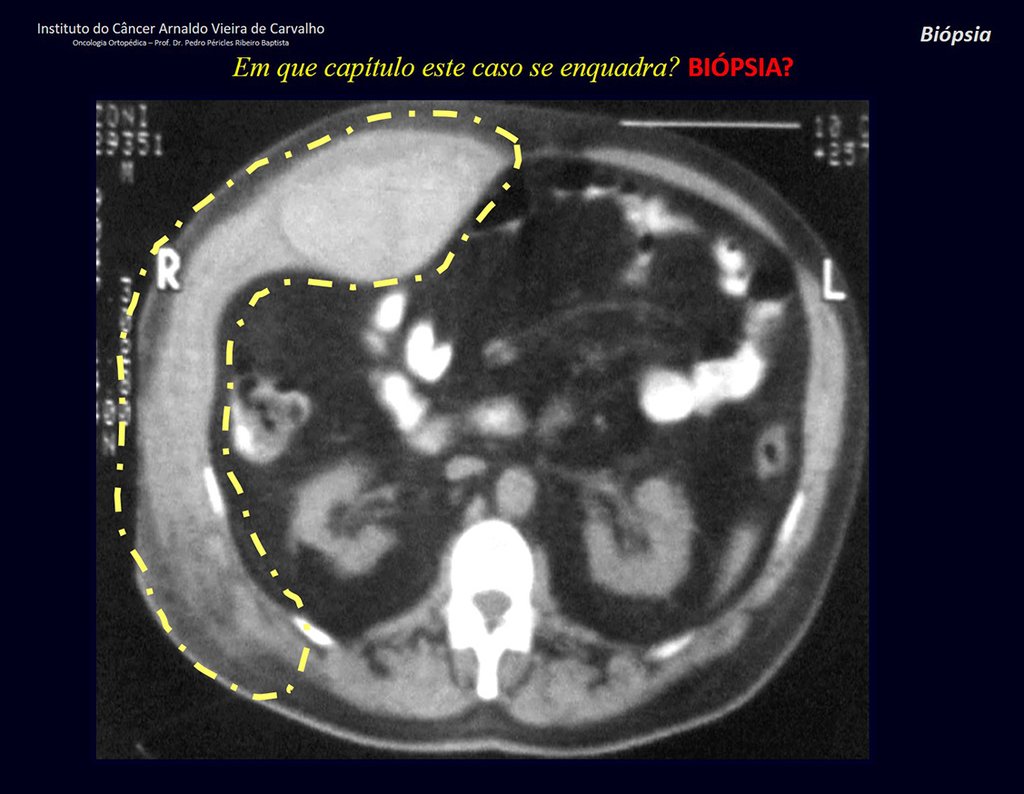 Figura 3: Tomografia com lesão na parede abdominal. Abaulamento do músculo reto anterior e espessamento da musculatura lateral, assinalado em amarelo.