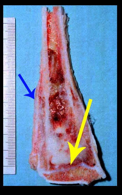 Figura 18: Corte da peça ressecada. A seta azul destaca a reação periosteal e a seta amarela salienta a proximidade do tumor à placa de crescimento.