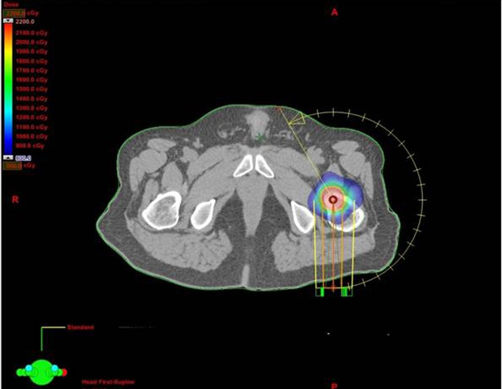 Figura 26 g: Imagem de TC em corte axial, com distribuição de dose da radiação e apresentação de linha amarela representado o eixo de rotação dos campos de radioterapia. Isodoses de tratamento: Vermelho: 2000 cGy (dose de prescrição); azul 500 cGy (baixa dose).