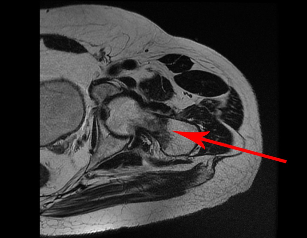 Figura 51: Outro corte de RM axial T1, evidente traço de fratura incompleta no colo femoral, com aumento do edema na medular, seta em vermelho.