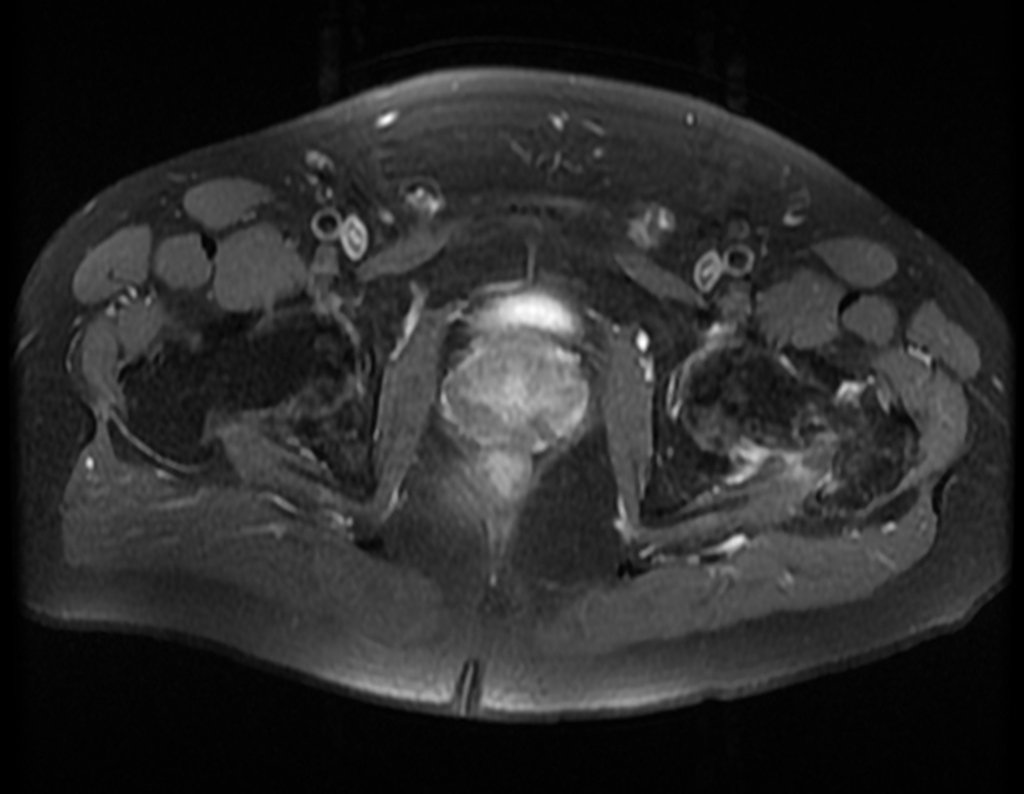 Figura 56: RM axial, fragilidade no colo e cabeça femoral.