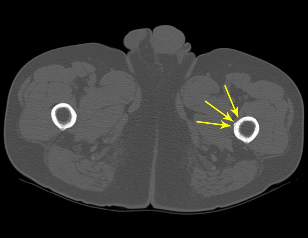 Figura 40: Tomografia com erosão em roído de traça na cortical da diáfise femoral subtrocantérica.