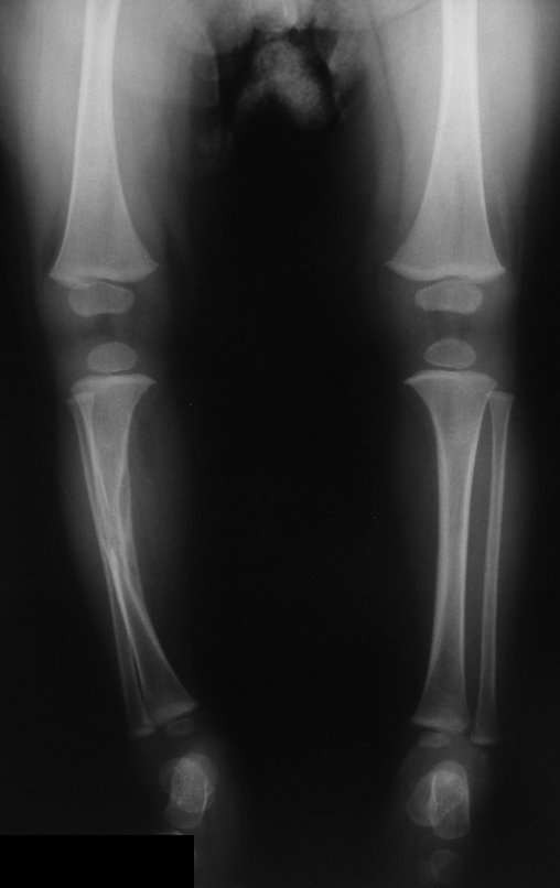 Figura 2: A radiografia da perna direita revela alteração na diáfise da tíbia, com áreas de rarefação e deformidade angular.