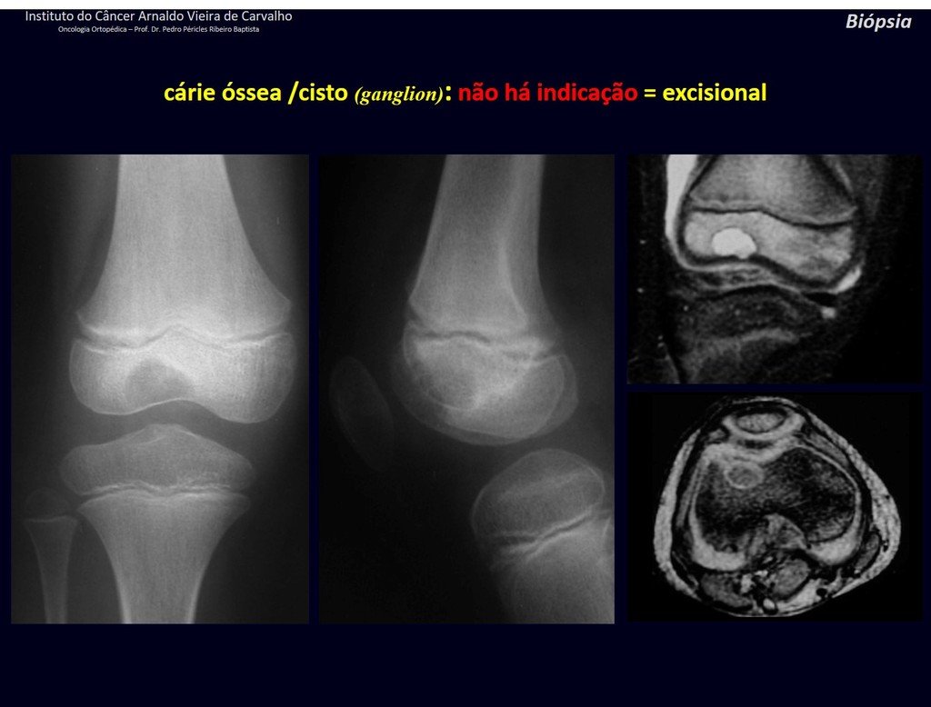 Figura 61: Lesão epifisária de rarefação óssea bem delimitada. Ressonância coronal e axial destacando o aspecto homogêneo e circunscrito da lesão. Ganglion? Provavelmente não, pois não há comunicação com a articulação. Provável cárie óssea, sequela de processo inflamatório.