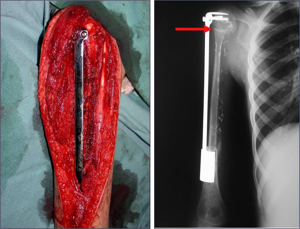 Figura 64: Reconstrução com autotransplante de placa de crescimento da fíbula, com microcirurgia. Radiografia da osteossíntese com o dispositivo extensível.