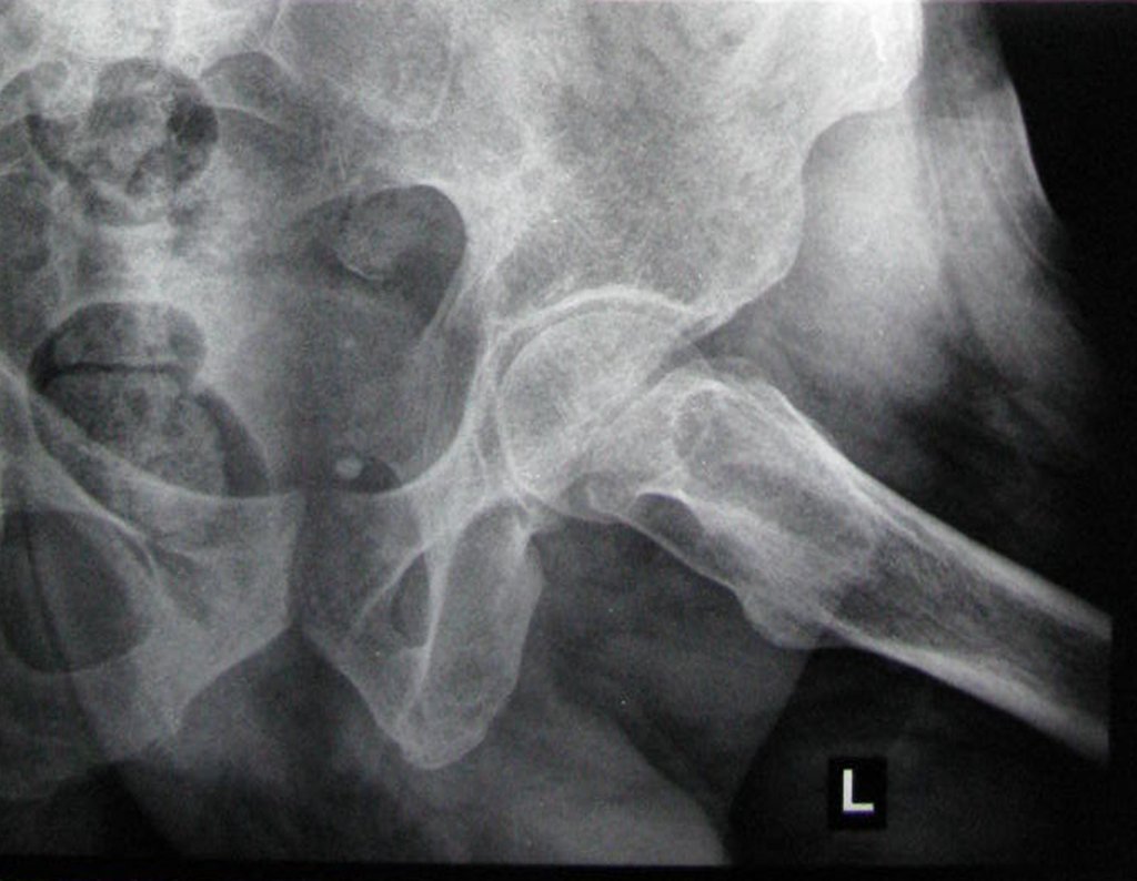 Figura 36: Radiografia de bacia em Lowentein com lesão póstero medial no colo femoral.