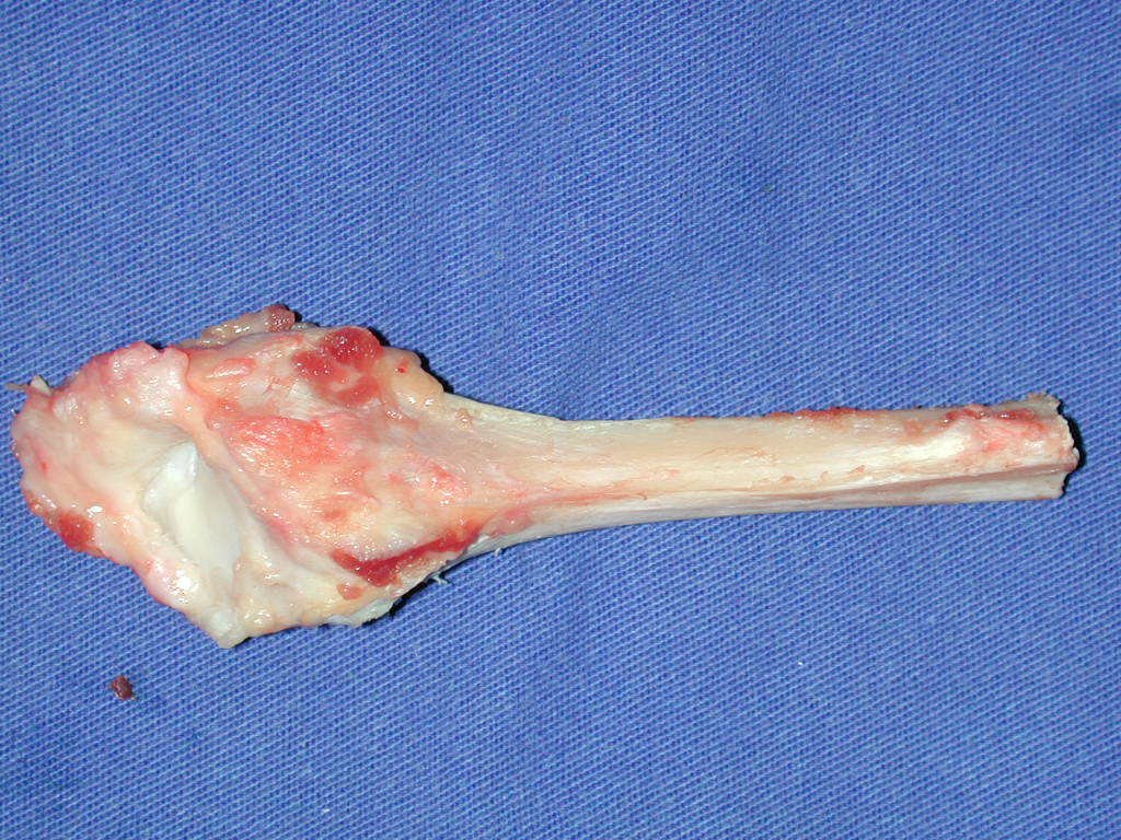 Figura 71: Segmento proximal da fíbula, com cápsula articular, que será utilizado na reconstrução do punho.