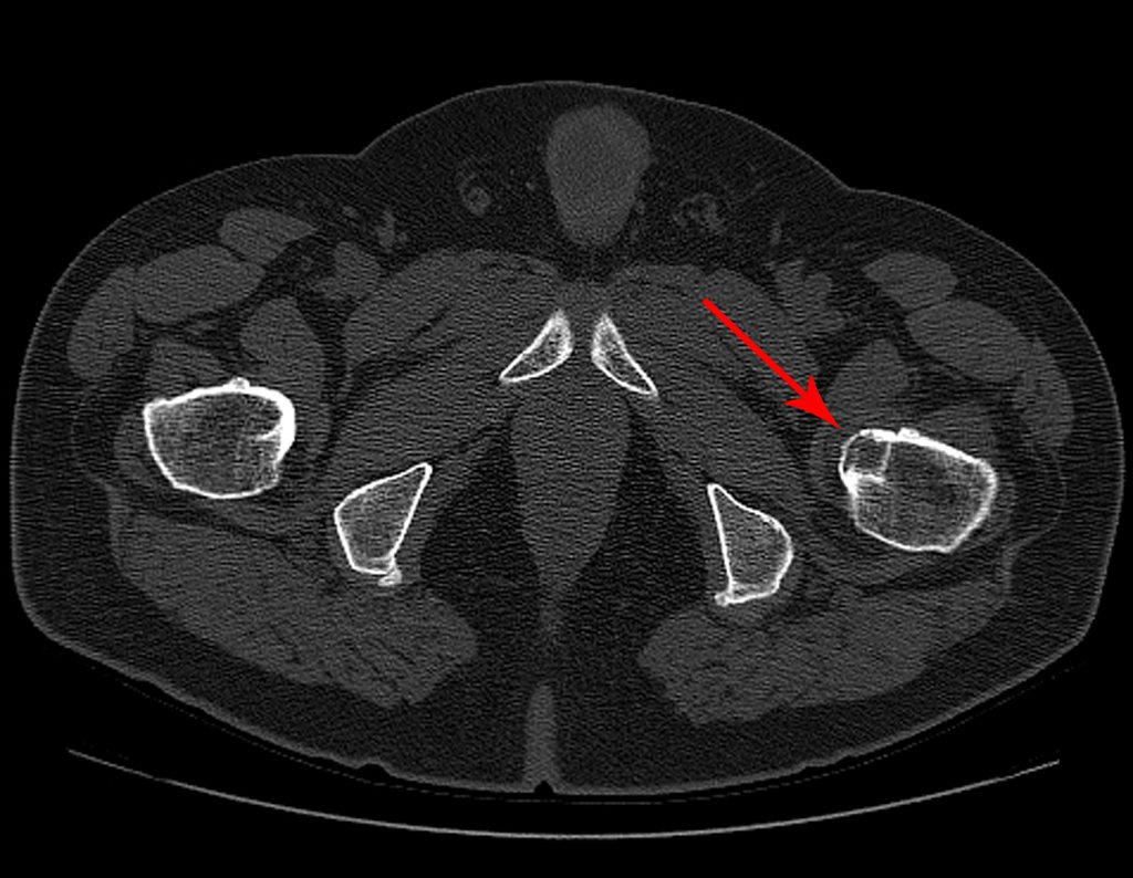 Figura 39: Tomografia axial com lesão lítica no pequeno trocânter e erosão da cortical.