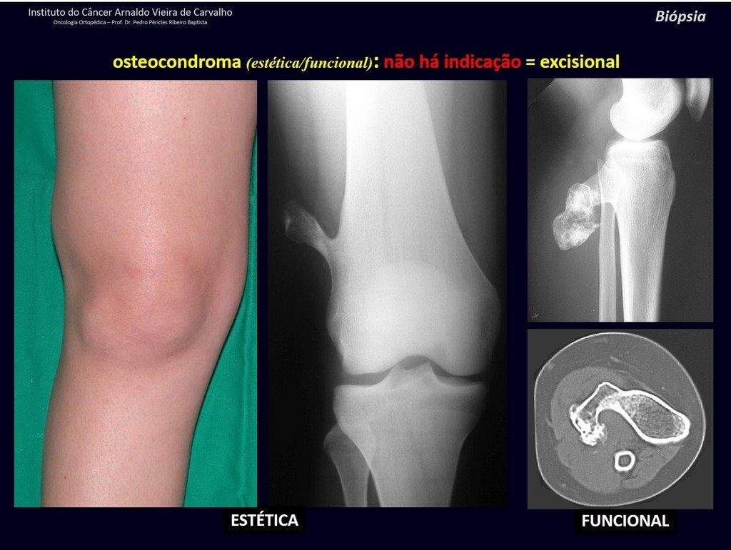 Figura 27: Exemplo de osteocondroma pediculado do fêmur e de osteocondroma pediculado da tíbia. A cortical do osso continua-se com a cortical da lesão e a medular do osso também se continua com a medular da lesão. Não há indicação de biópsia.