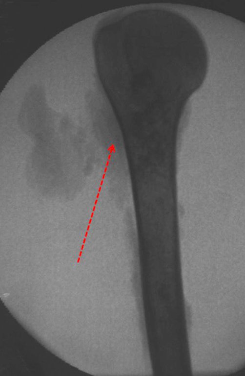 Figura 21.B: Radiografia da peça documentando os tecidos moles ressecados.