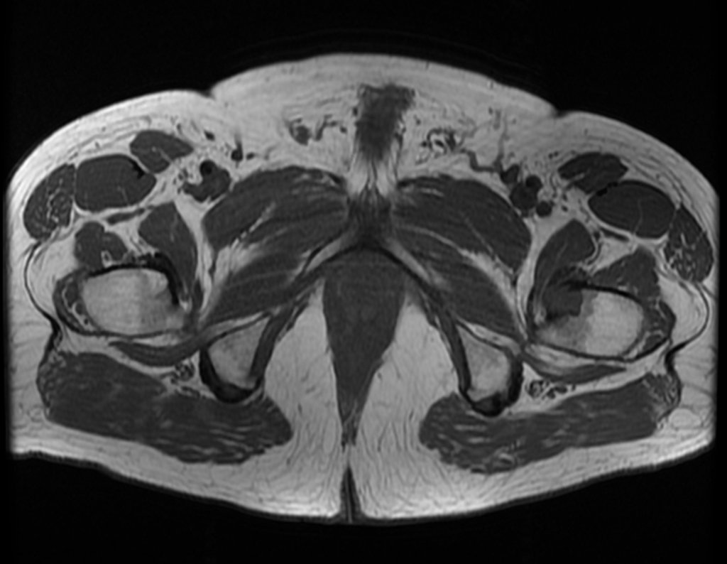 Figura 4: RM axial T2, lesão de baixo sinal no pequeno trocânter e edema medular.