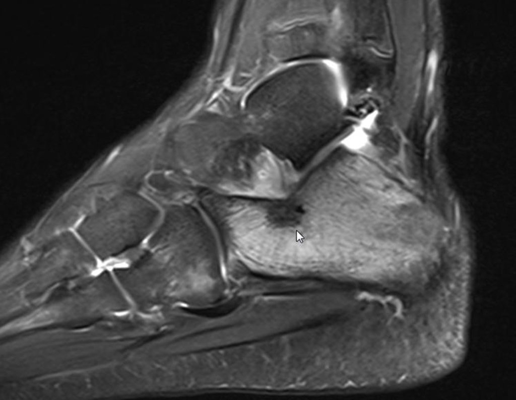 Figura 28: RM sag T2 stir, permanência da lesão e edema.