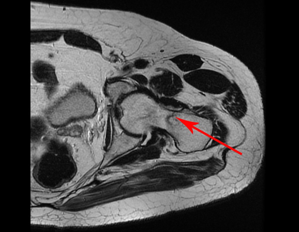 Figura 45: RM axial T1 com traço de fratura incompleta no colo femoral, seta em vermelho.