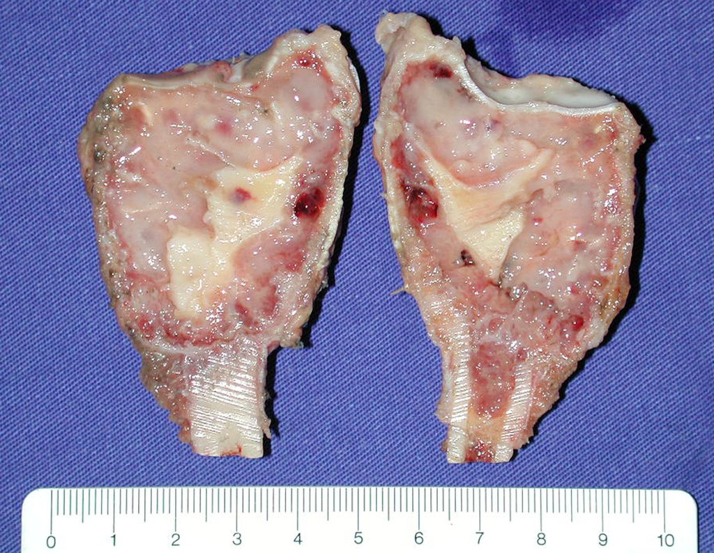 Figura 57: Aspecto macroscópico do corte da peça cirúrgica, sem tumor extracortical e, portanto, sem invasão de tecidos moles, conforme afirmamos anteriormente.