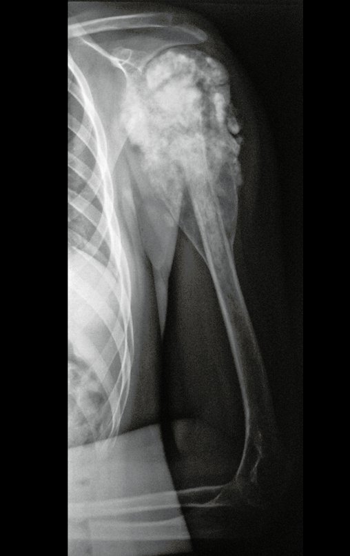 Figura 2: Radiografia do úmero esquerdo oblíqua, com mineralização da lesão por resposta favorável à quimioterapia pré-operatória.