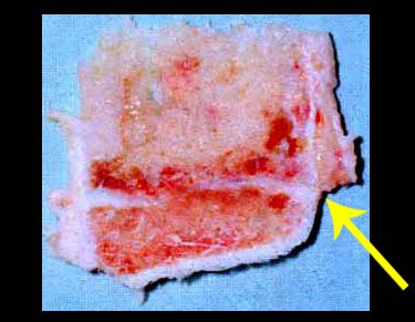 Figura 20: Detalhe da proximidade da placa de crescimento como tumor.