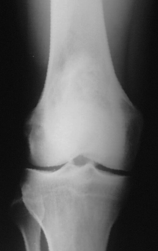 Figura 46: Radiografia do joelho operado, frente, com enxerto totalmente integrado. Restauração integral da anatomia.