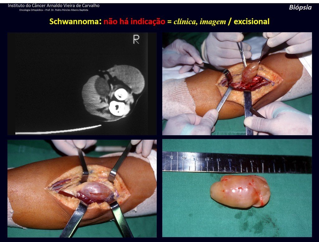 Figura 75: Ressonância evidenciando lesão em tecidos moles no trajeto do nervo interósseo posterior. Sinal de tinel positivo. SCHWANNOMA. Ressecção biópsia, abrindo o perineuro e enucleando o tumor, que se desprende facilmente ("como o caroço do abacate").