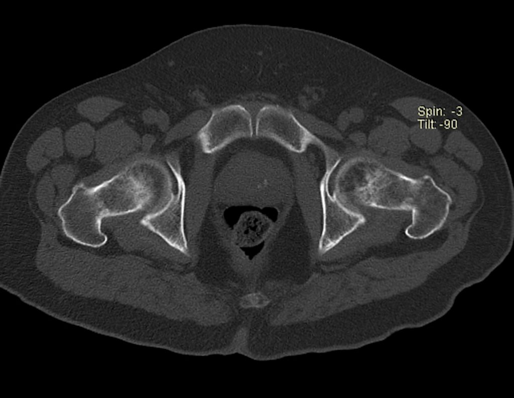 Figura 65: Tomografia axial com rarefação na cabeça femoral esquerda.