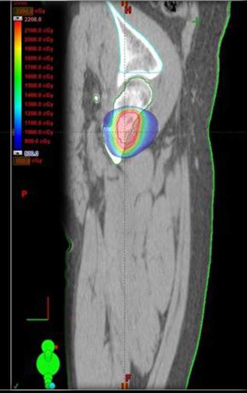 Figura 26e: Imagem de TC em corte sagital, com distribuição de dose no fêmur esquerdo. Isodose de tratamento: Vermelho: 2000 cGy (dose de prescrição); azul 500 cGy (baixa dose).