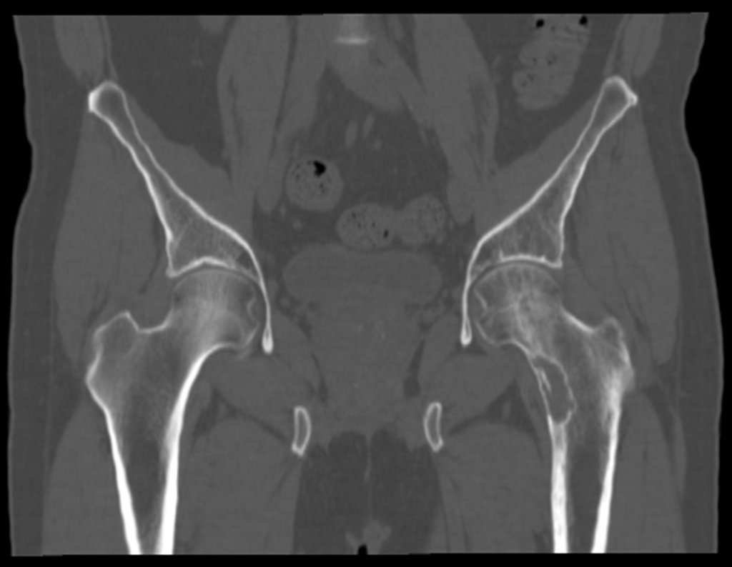 Figura 37: Tomografia coronal com lesão lítica e erosão da cortical medial maior que um terço do colo, indicativo de cirurgia, devido a iminência de fratura.