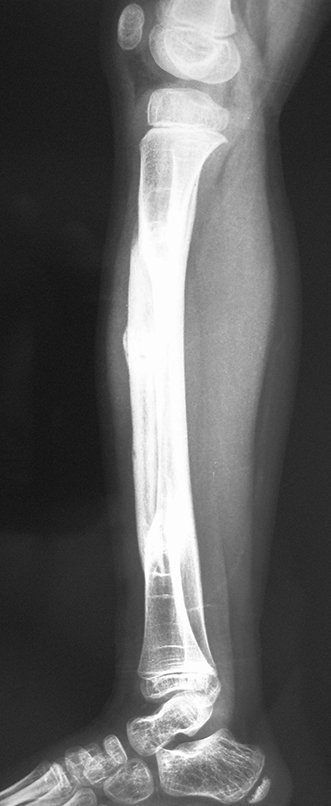 Figura 122: Radiografia de 29/05/2012, perfil, com fratura de stress!!!