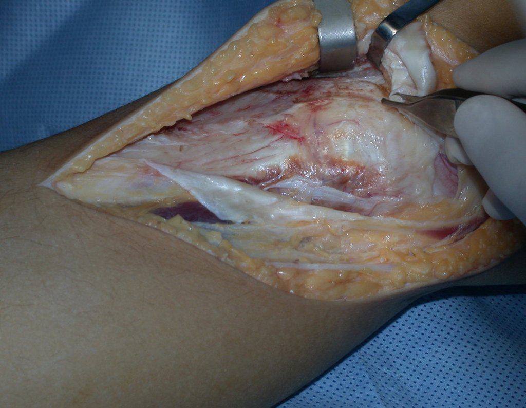 Figura 39: Podemos observar a continuidade deste descolamento proximal e lateral, observando que o ligamento patelar é cuidadosamente liberado. Isto permitirá a sua reinserção firme na prótese e proporcionara a melhor função do quadríceps.