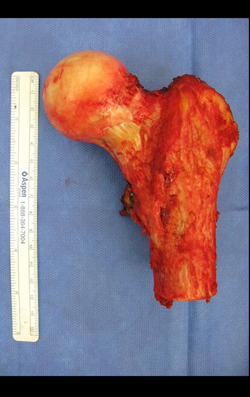 Figura 97: Segmento ressecado, face anterior.