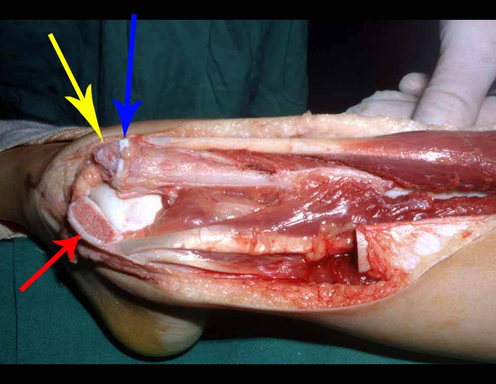 Figura 12: Retirada da cartilagem epifisária da fíbula, seta amarela, com preservação da placa de crescimento da fíbula, seta azul, detalhe do maléolo tibial, seta vermelha.