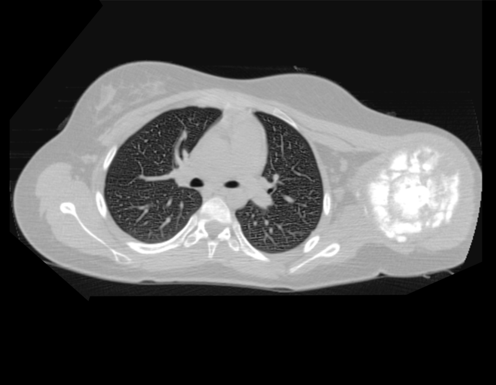 Figura 11: Tomografia com densidade para tecidos ósseos, ressaltando o volume tumoral.