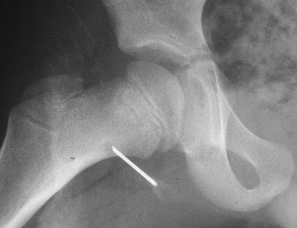 Figura 27: No intraoperatório, ao abrir o colo femoral, visualizamos o orifício realizado e documentamos radiograficamente.