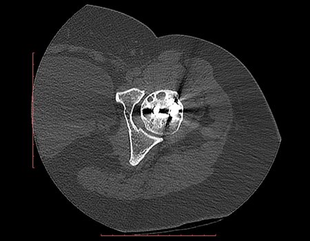 Figura 102: Tomografia da cabeça femoral, após doze anos, observamos pequenas áreas císticas remanescentes.